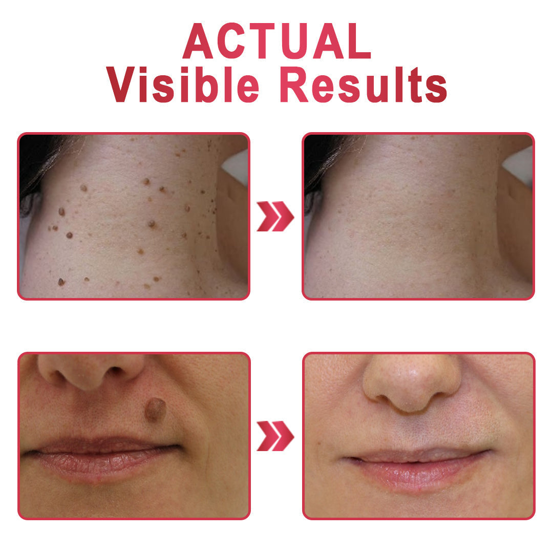 ✨KISSHI™ WipeOffEase Tags & Moles Remover ✨